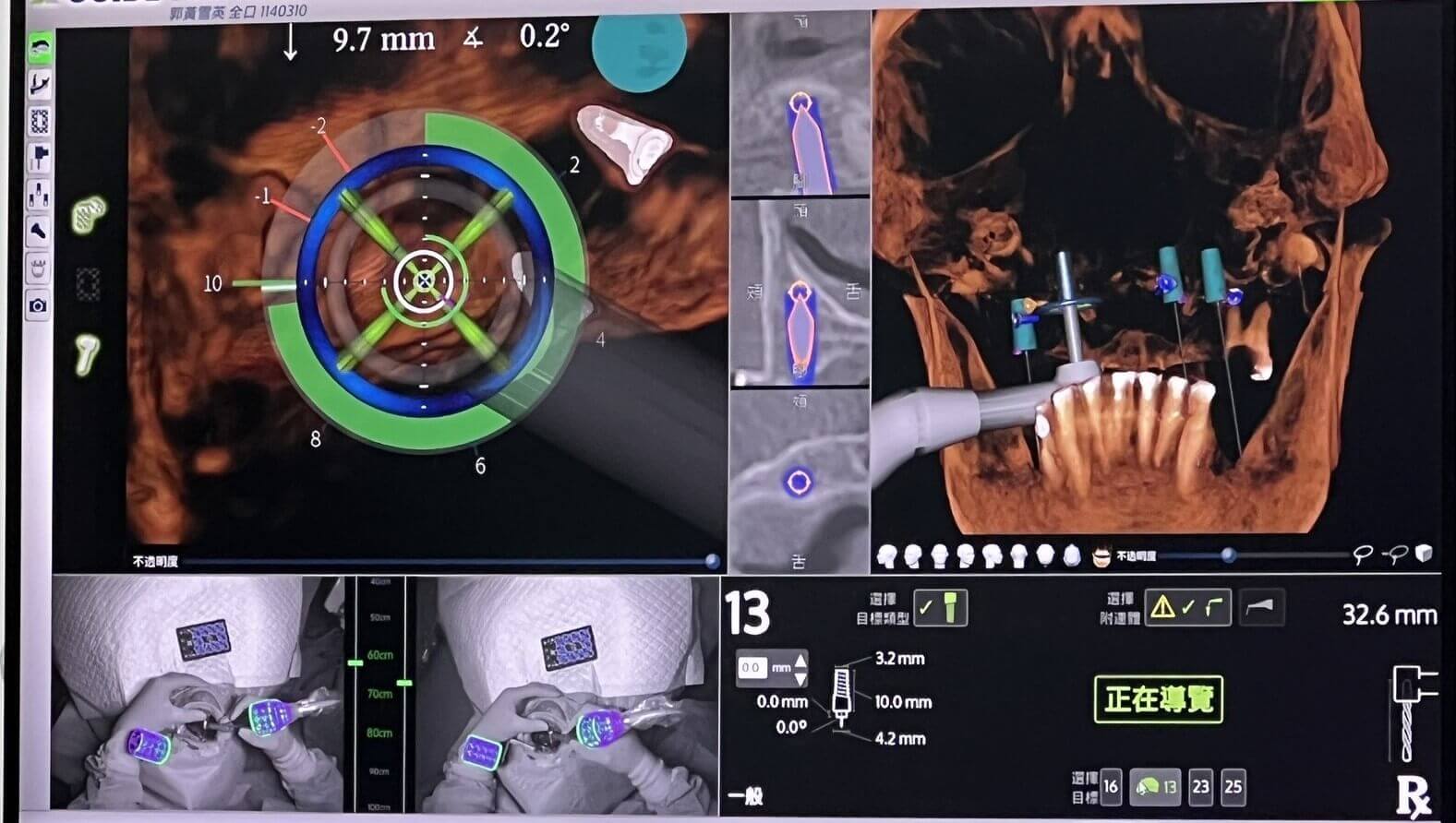 SEO 圖片很重要:導航植牙畫面